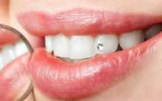 Накладки на передние зубы: фото виниров, клипс и других протезов для красоты улыбки