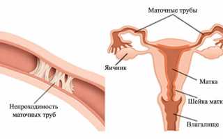 Непроходимость маточных труб: причины, симптомы и методы лечения