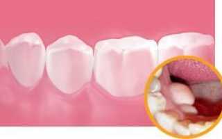 Что делать при оголении надкостницы, если после удаления зуба из десны торчит кость?