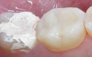Что делать, если поставили пломбу с мышьяком, а зуб болит: почему это происходит?