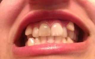 Что такое мертвый депульпированный зуб, сколько живет единица без нерва, каковы причины почернения и особенности ухода?