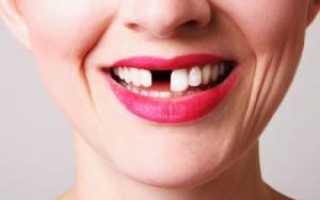 Почему у взрослых людей могут выпадать постоянные зубы, что с этим делать?