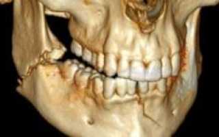 Лечение перелома нижней челюсти: симптомы и классификация травмы, первая помощь и последствия