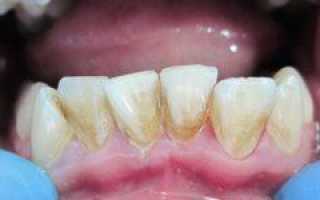 Причины налета на молочных зубах у детей желтого, коричневого, серого или белого цвета и способы его устранения