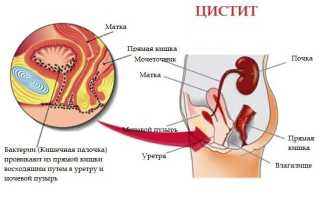 Воспаление мочевого пузыря у женщин: причины, симптомы, лечение