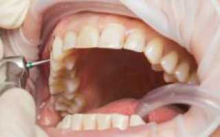 Препарирование зубов под металлокерамическую коронку: клинические этапы на видео, больно ли делать обточку?