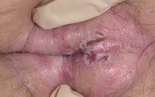 Лейкоплакия вульвы у женщин: описание, характерные симптомы, способы лечения