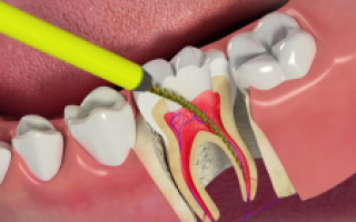Зачем человеку нужен в зубе нерв, где он находится и как выглядит?