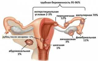 Признаки внематочной беременности на ранних сроках: причины, классификация, симптомы, лечение