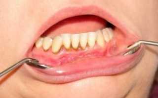 Лечение или удаление: что делать, если гниют зубы изнутри до десны или корня, какими будут последствия?