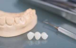 Металлопластмассовые и металлокерамические зубные протезы: отличия, показания и противопоказания, фото