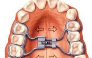 Расширение узкой челюсти у детей и взрослых: основные методы и аппараты