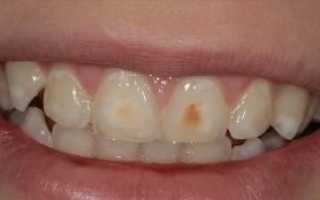 Пятна, точки и полосы на зубах у взрослого и ребенка: как избавиться и почему они появляются?