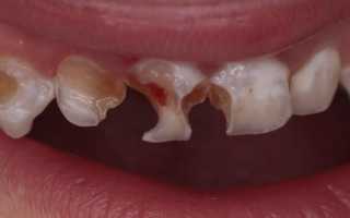 У ребенка гнилые зубы: почему гниют молочные зубки, что делать и как лечить?