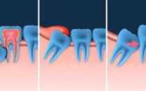 Как снять опухоль с десны и щеки от зуба в домашних условиях с помощью медикаментов и народных средств?