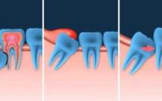 Как снять опухоль с десны и щеки от зуба в домашних условиях с помощью медикаментов и народных средств?