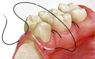 Варианты осложнений после имплантации зубов на нижней и верхней челюсти: отек, боль и воспаление десны