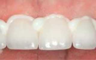 Цемент, клей и другие материалы для фиксации зубных коронок в клинике и домашних условиях