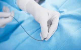 Эмболизация маточных артерий, как современный метод лечения миомы матки у женщин