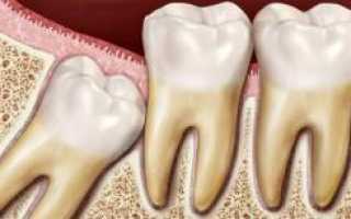 Какие осложнения могут возникнуть после удаления зуба мудрости на верхней и нижней челюсти?