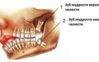 Зуб мудрости на верхней челюсти: в каких случаях необходимо удаление и каковы последствия?