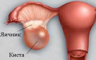 Ретенционная киста яичника у женщин: симптомы, причины развития, методы лечения